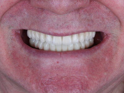 Зубные импланты на обе челюсти